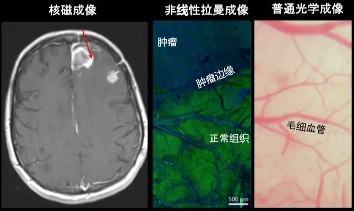 020 核磁成像（左）能看到大脑中的肿瘤.webp.jpg